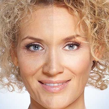 Superficial Level 2 Skin Peels